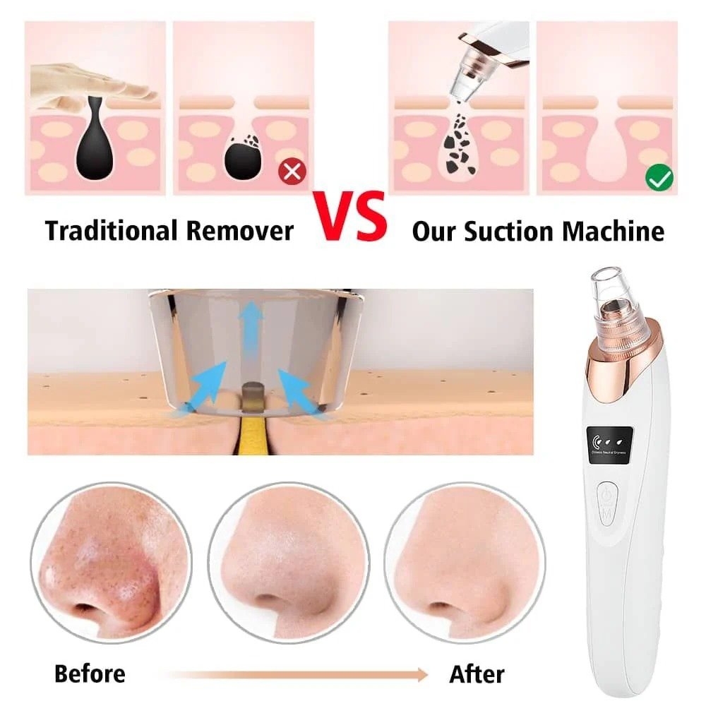 Blackhead Remover Vacuum – 5 Suction Heads, USB Rechargeable - Image 3